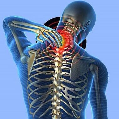 Hals Schmerz mat Gebärmutteral Osteochendrosis
