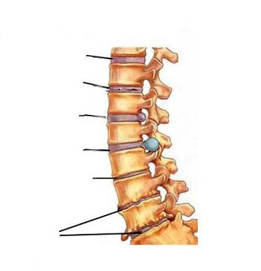 Wéi d'Osteochondoss entwéckelt sech
