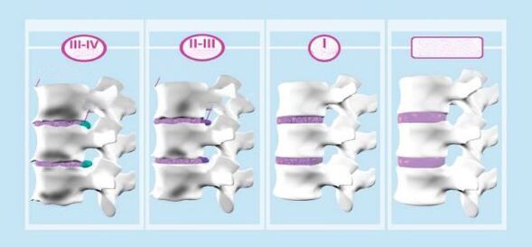 Zänn vun cervical Osteochondrosis