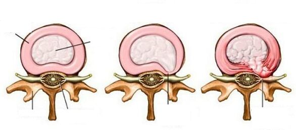 intervertebrale Hernia mat Gebärmutterhals Osteochonds