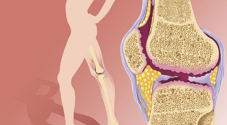 Iwwergewiicht féiert zu Arthrosis