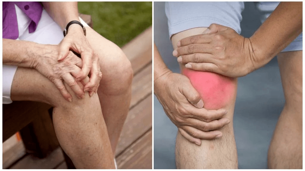 Behandlung vun Arthrosis