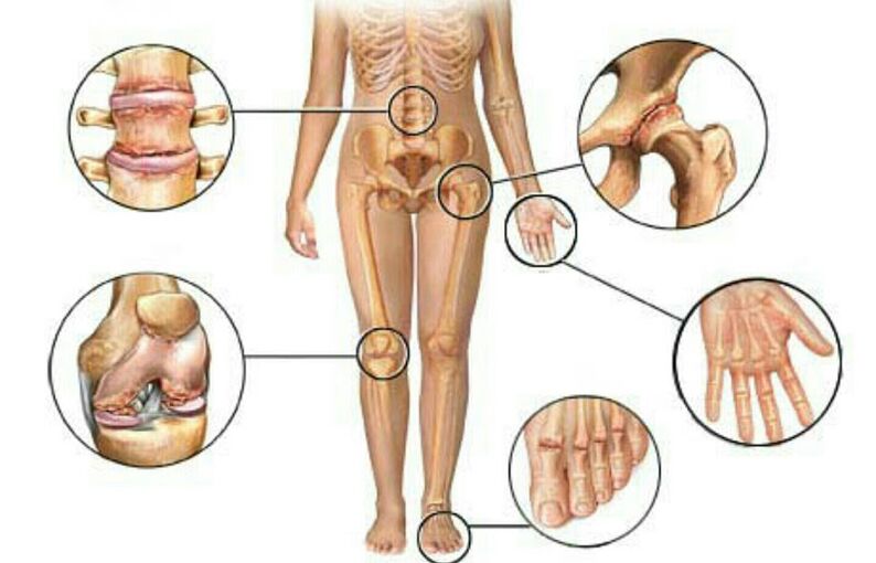 Aarte a Grad vu Arthrosis